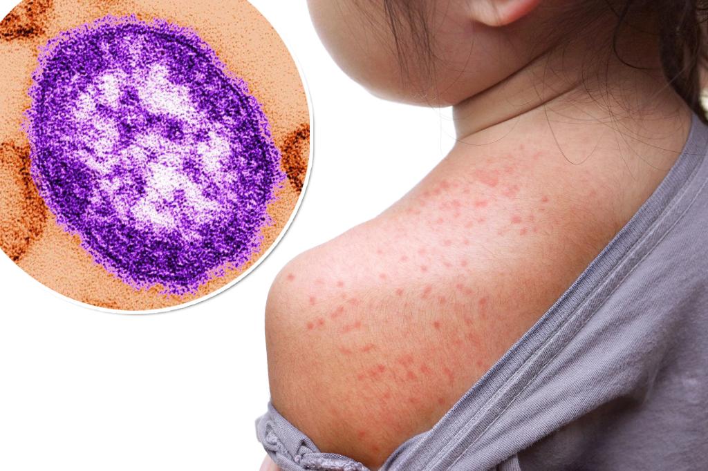 Measles is back in 2 states â what to know before the next outbreak